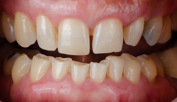 Broken, chipped, crooked, discoloration teeth