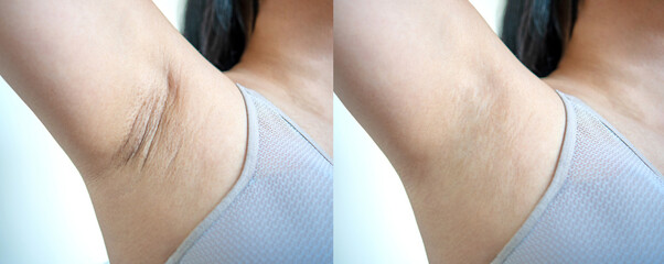 Asian woman with underarm chicken skin problem, Fox Fordyce, black armpit in woman. before and...