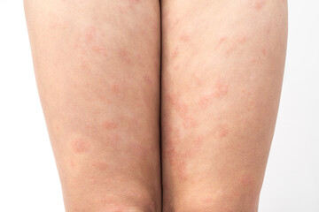 Acute atopic dermatitis on the feet of a child is a dermatological skin disease. Large, red, inflamed, scaly rash on the legs. Legs of a teenager with severe atopic eczema.