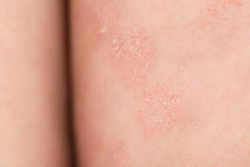 Close-up severe atopic eczema on the legs behind the knees of a child is a dermatological disease...