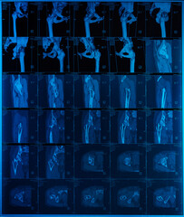 Magnetic resonance imaging (MRI) of the pelvis, femoral joint, titanium nail in the bone after a...