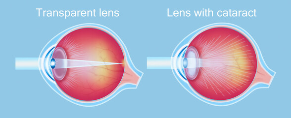 Cataracts and healthy eye detailed structure.