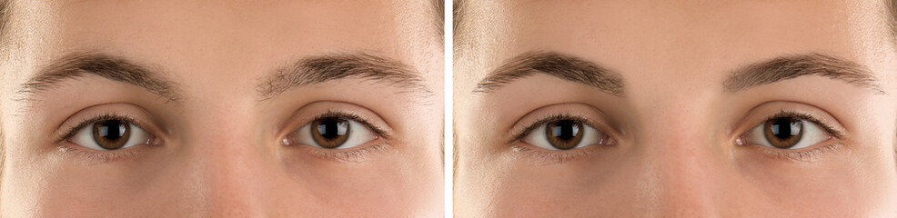 Collage with photos of man before and after eyebrow modeling, closeup. Banner design