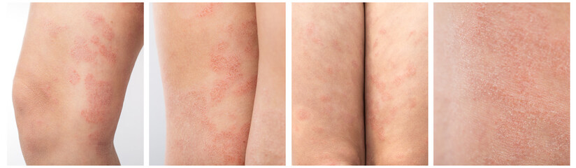 Panel Collage about acute atopic dermatitis on the legs of a child is a dermatological disease of the skin. Large, red, inflamed, scaly rash on the legs. Legs of a teenager with severe atopic eczema. - obrazy, fototapety, plakaty