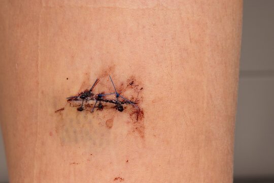 Three Stitches holding wound on thigh together after suturing with dried up blood and small bruise.