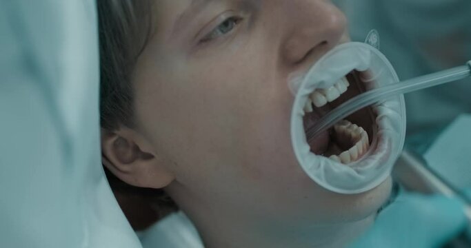 A male patient is wearing a mouth opener and having his mouth wide open, he is having a saliva ejector put inside his mouth, and after that an intraoral digital scanner is being inserted and turned on