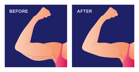 Arm with excess skin before and after surgical operation. Saggy skin removal and arm before and after toning exercises