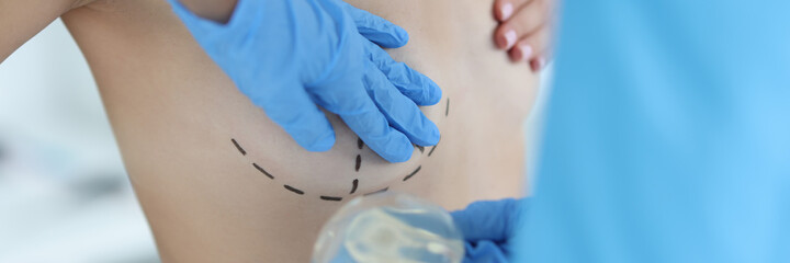 Plastic surgeon's hands are holding breast implant in front of nude patient with lines drawn with marker close-up. Preoperative preparation for breast augmentation concept.