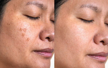 Image before and after spot melasma pigmentation facial treatment on asian woman face. skincare and...