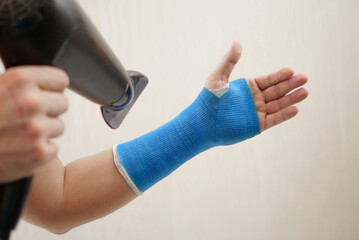 Male hand wrapped in fiberglass plaster cast dries with a hairdryer. Broken wrist in a modern waterproof bandage
