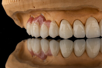 Fototapeta na wymiar Close-up photo of a dental upper jaw prosthesis on black glass background. Artificial jaw with veneers and crowns. Tooth recovery with implant. Dentistry conceptual photo. Prosthetic dentistry.
