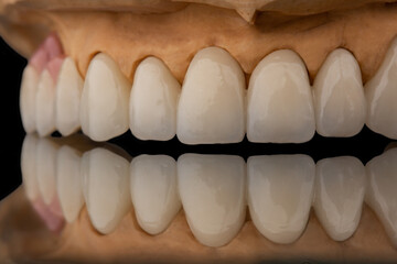 Close-up front view of a dental upper jaw prosthesis on black glass background. Artificial jaw with veneers and crowns. Tooth recovery with implant. Dentistry conceptual photo. Prosthetic dentistry.