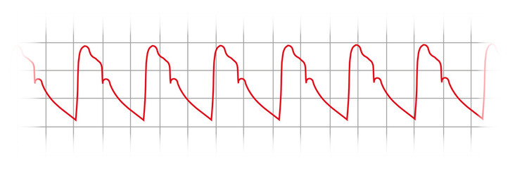 Invasive Blood Pressure Waveform - Arterial pulse