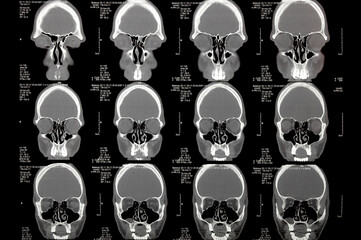 CT head image