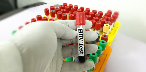 Blood sample with Hepatitis B virus (HBV) at lab