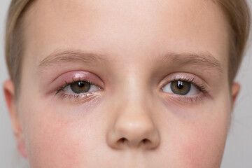 Selective focus, concept. Girl 10 years old close up portrait. One eye has barley. Grey background.