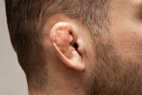 Damaged and broken cartilage
of ear. Most famous injury for wrestlers and fighters.