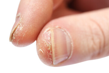 Fototapeta premium Atopic dermatitis (AD), also known as atopic eczema, is a type of skin inflammation (dermatitis) on the fingers.