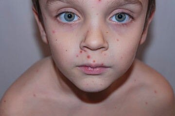 Chickenpox, fever and runny nose. The boy is sick on the face and body. Chickenpox virus, chickenpox outbreak in children.