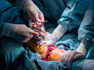 in an operating room lower leg amputation is performed