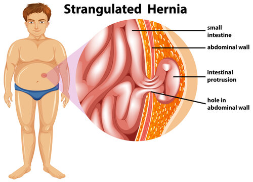 Man with strangulated hernia