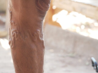 The severity of the varicose veins ranges from the tiny capillaries, pain in the legs, swollen feet...