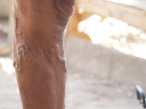 The severity of the varicose veins ranges from the tiny capillaries, pain in the legs, swollen feet and legs, and the crooked aneurysm resembles a worm.