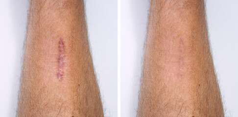 Result after procedure of scar removing. Scar surgery or laser removal. Skin imperfections or...