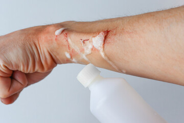 Treatment of a bleeding wound on the body with medical preparations. Step by step. Step 2.