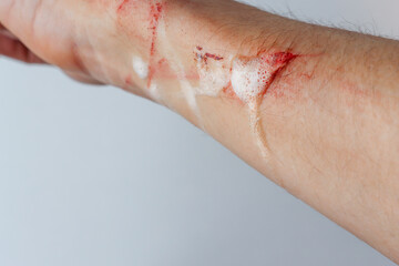 Treatment of a bleeding wound on the arm. Decontamination of the wound. Applying a bandage to a fresh wound.