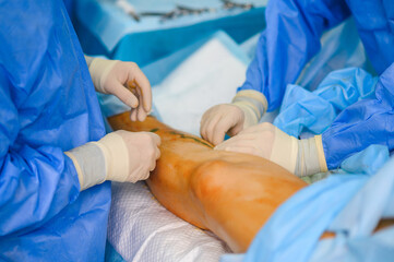 Preparing the patient for phlebectomy surgery. Surgical field marking