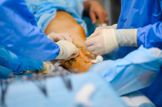 Preparing the patient for phlebectomy surgery. Surgical field marking
