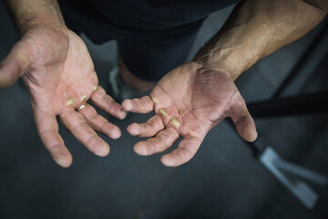 Large calluses on the muscular arms of an athlete