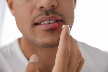 Man with herpes applying cream on lips against light background, closeup - obrazy, fototapety, plakaty