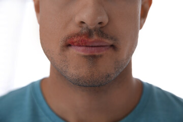 Man with herpes on lip against light background, closeup