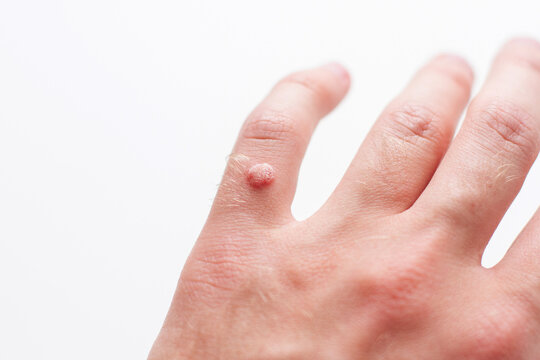 Closeup of finger wart isolated on white background. Skin diseases. Viral wart on hand