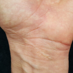 Stitched surgical scar on the hand.