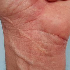 Stitched surgical scar on the hand.