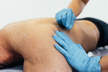 Physiotherapist performing a dry needling treatment on a sick patient with back pain. Health concept