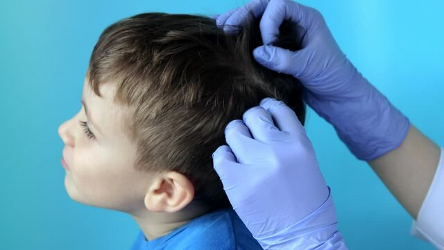The pediatrician in the gloves will check the presence of lice and nits in a small child. Pediculosis in kindergarten, preventive examination of the head and hair.