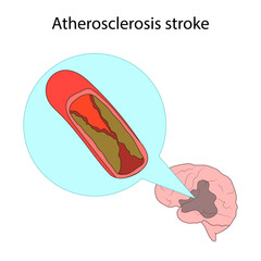 Types of stroke. Atherosclerosis. Brain disease. Medical illustration.