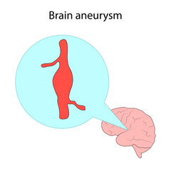 Types of stroke. Brain aneurysm. Disease. Medical illustration.