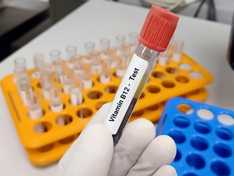 Test Tube with blood sample for Vitamin B12 (cobalamin) test. Macrocytic anemia. Folate. . A medical testing concept in the laboratory background.