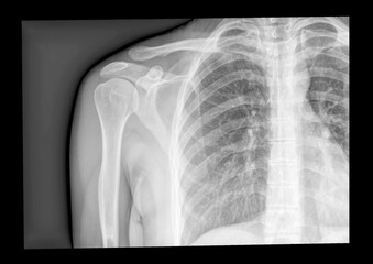 x-ray shoulder radiograph displaying Acromioclavicular sprain disruption, sports injury
