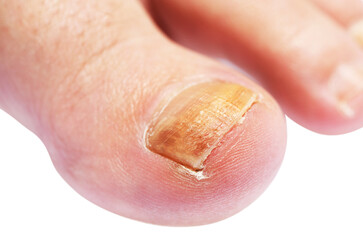 Close-up image of toenail fungus on a white background
