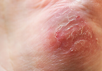 Fototapeta premium Atopic dermatitis (AD), also known as atopic eczema, is a type of skin inflammation (dermatitis) on the hand.