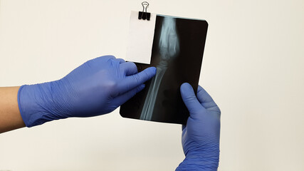 a doctor wearing medical gloves is holding an X-ray. broken arm in the picture