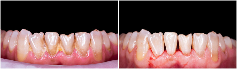 Obraz premium teeth cleaning before and after picture