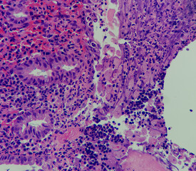 Photo of amebic colitis, focus on ameba along mucosal surface, magnification 400x, photo under...