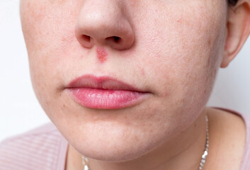 Cold sore or herpes under the nose of a young woman. 